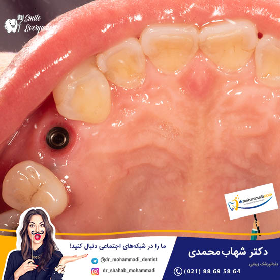 ایمپلنت ارزان چه تفاوتی با ایمپلنت گران دارد؟ - کلینیک دندانپزشکی دکتر شهاب محمدی